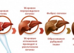 Цироз печени: страшный диагноз