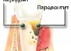 Пародонтит. Причины. Методы лечения