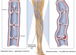 Варикозное расширение вен: первые симптомы и лечение