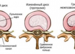 Межпозвонковая грыжа: симптомы и методы лечения