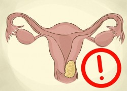 Рак шейки матки: причины, симптомы