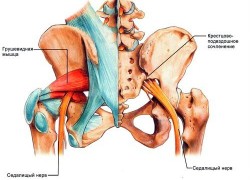 Как распознать воспаление седалищного нерва