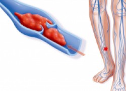 Все, что нужно знать о тромбозе и ТЭЛА 