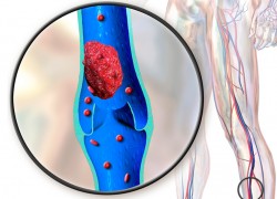 Три главных симптома тромбоза глубоких вен 