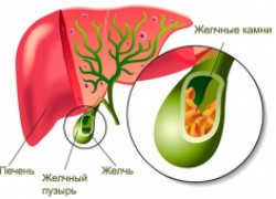 Чем опасен холецистит и что будет, если его не лечить 