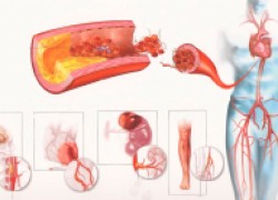 Атеросклероз​​​​​​​: не запусти свои бляшки 