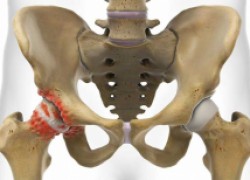 Коксартроз: как не перепутать с другими заболеваниями, как распознать, как лечить 